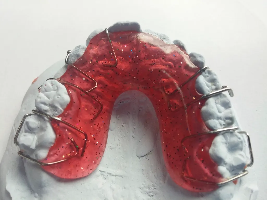 A pink removable orthodontic appliance with metal wires resting on a white plaster dental model