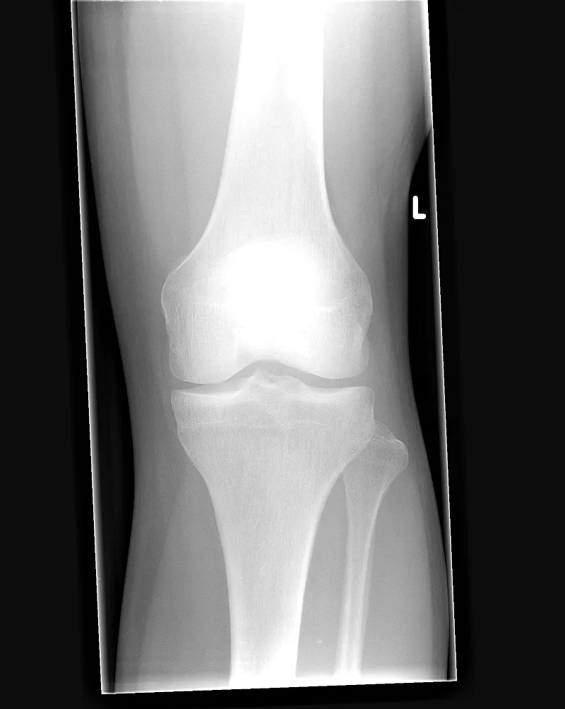 Front-view X-ray of a human knee joint on a black background